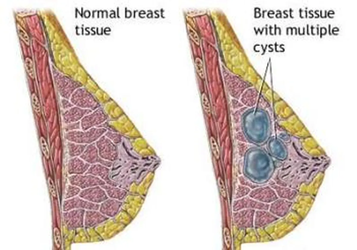 Fibrocystic breast disease